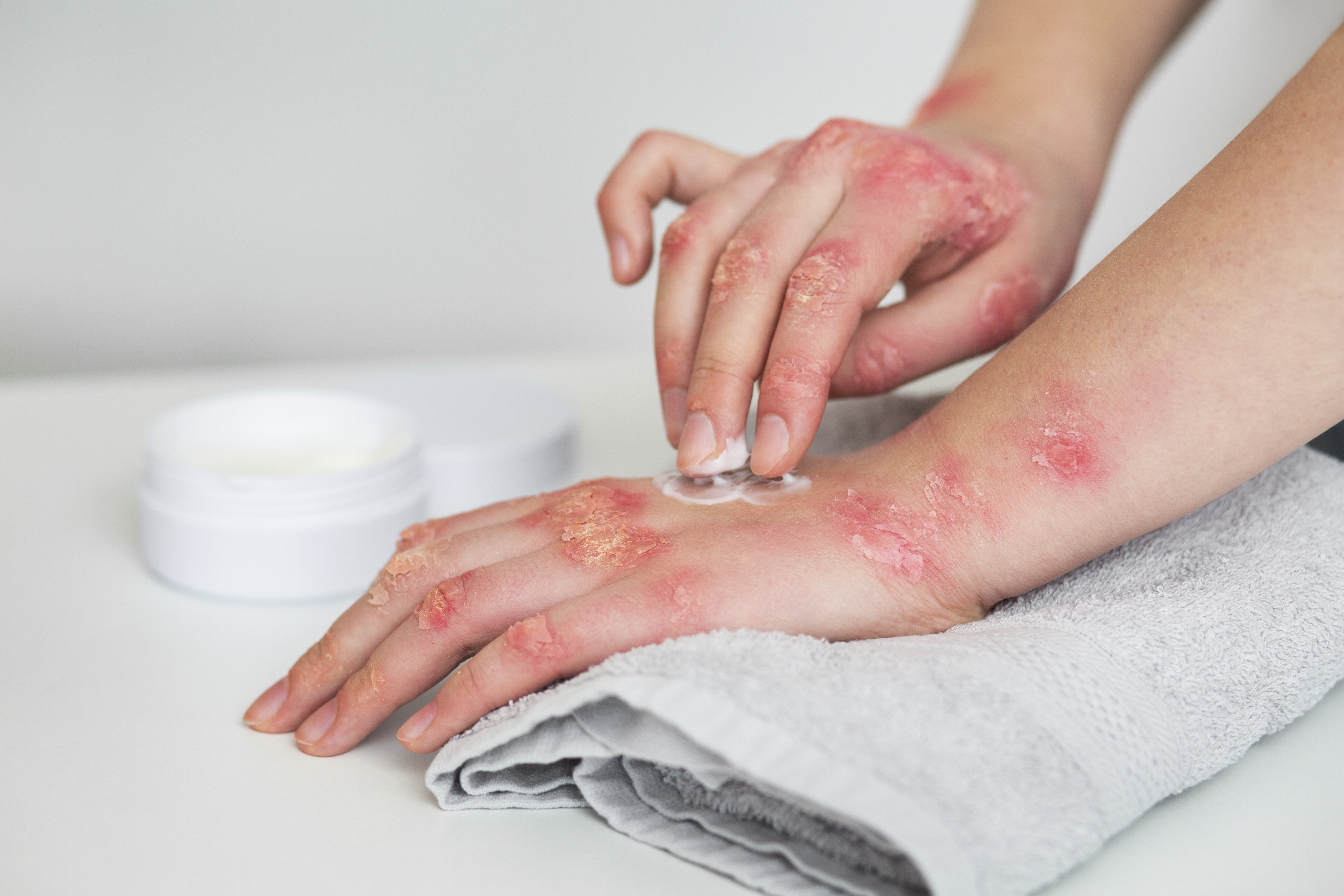 Burn Contracture Surgery