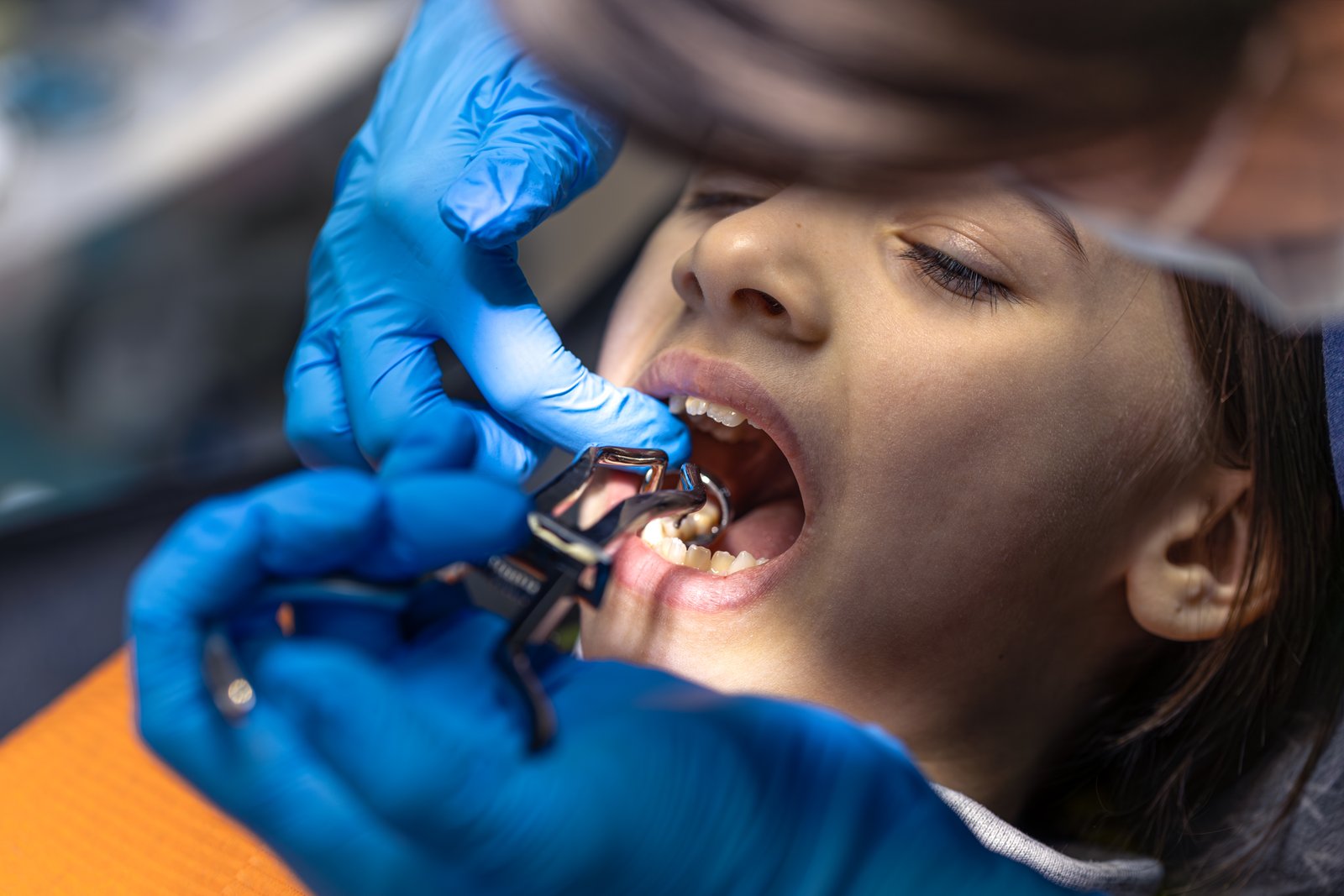 Cleft Lip and Palate Surgery